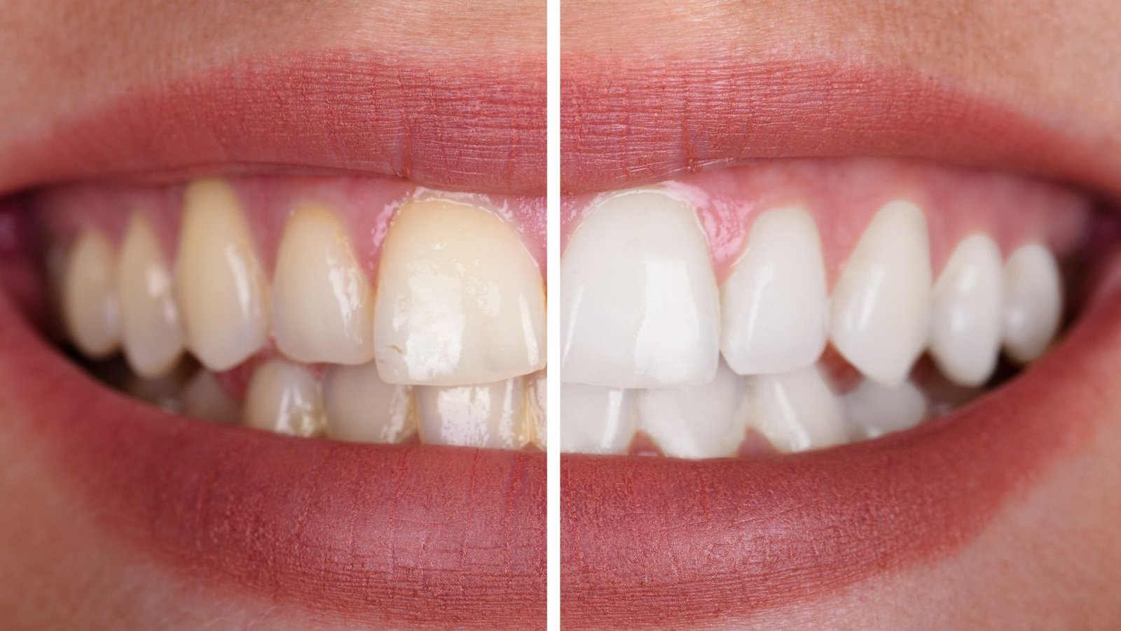Professional Tooth Whitening