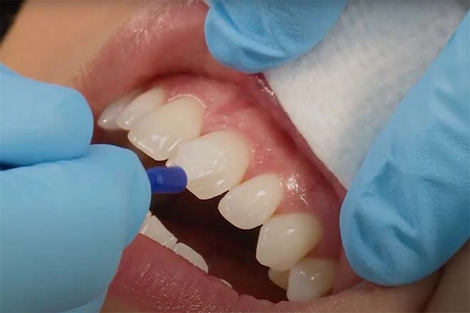 Remineralising Treatments