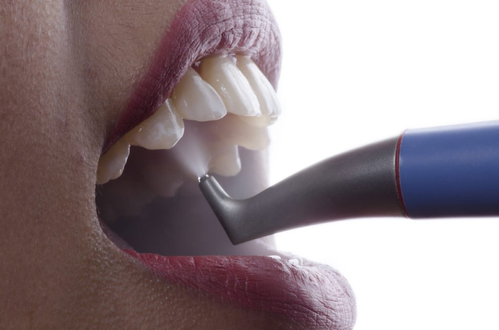 Air Polishing (AIR-FLOW Therapy)