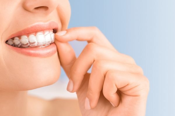 ClearSmile Aligners